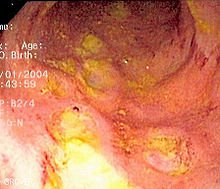 Endoskopowy obraz zapalenia jelita w chorobie Crohna ukazujący głębokie owrzodzenie.
